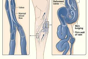 Varicose_veins.jpg