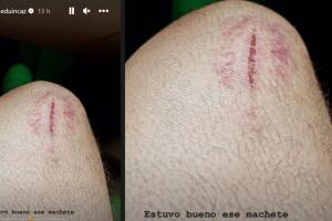 Eduin Caz mostró la herida que le dejó el accidente que sufrió con un par de machetes en pleno concierto.