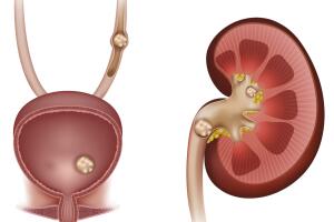 Belinda fue operada para retirarle piedras del riñón