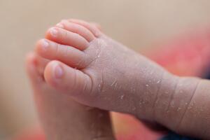 Palmoplantar psoriasis, allergic contact dermatits and atopic dermatitis in infants.