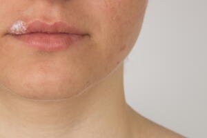 labios-ferida-herpes.jpg