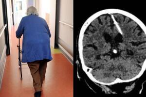 Médicos encuentran aguja en cerebro de una mujer de 80 años.