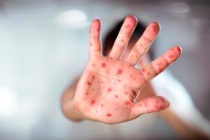 Identifican dos nuevos casos de sarampión en el Condado de Maricopa