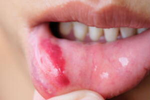 ter-herpes-oral-3.jpg