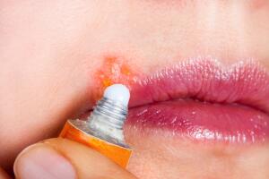 Los fuegos labiales son señal de herpes