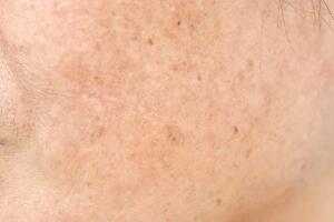manchas-brancas-pele-rosto-0619-1400x800.jpg
