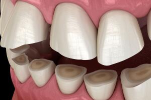 dentes trincados bruxismo 0422 1400x800