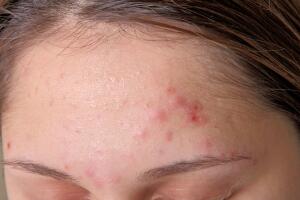 acne-pele-beleza-082016-1400x800.jpg