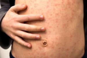 brote sarampión Texas dónde ponerte la vacuna gratis