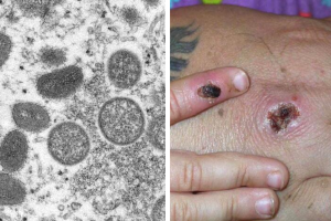 síntomas-viruela-mono-contagia