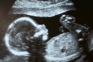 ultrassom-gravidez-feto-1217-1400x800.jpg