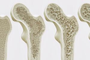 avance-osteoporosis-huesos-.jpg