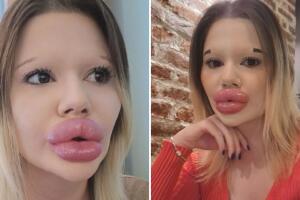 Gastó más de 9 mil dólares para convertirse en la mujer con "los labios más grandes del mundo"