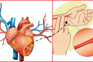 arritimia-cardiaca-_o-que-causa-2.jpg