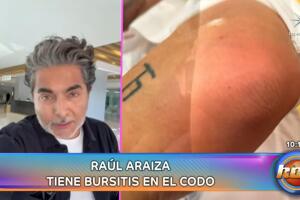 El diagnóstico de Raúl Araiza es "bursitis" en el codo.