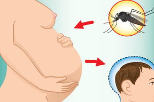 zika-virus-causa-microcefalia-2_0.jpg