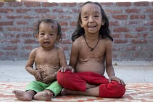 sindrome-benjamin-button-010.jpg